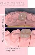 Image result for Overlay Dental