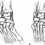 Image result for Spina Bifida Foot