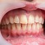 Image result for Bad Teeth and Gums