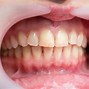 Image result for Gingival Papilloma Problems