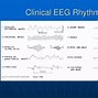 Image result for SSS EEG Pattern