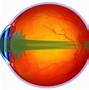 Image result for Laser Vision Correction