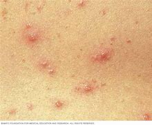 Image result for Chicken Pox Day 1