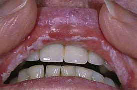 Image result for Mouth Yeast Infection Symptoms