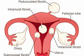 Image result for Type II Fibroid