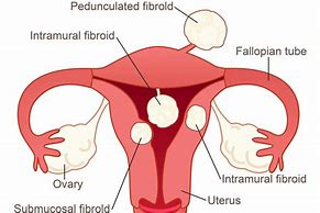 Image result for Posterior Fundal Fibroid
