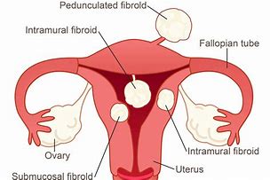 Image result for Fibroid On Ovary
