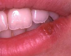 Image result for 1 Herpes