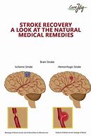 Image result for Stroke Recovery Disease