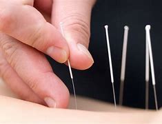 Image result for Acupuncture Full Body