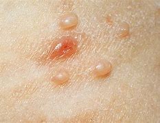 Image result for Molluscum Contagiosum On Finger