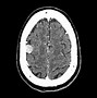 Image result for Gross Brain Image Meningioma