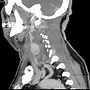 Image result for Bulging Carotid Artery in Neck