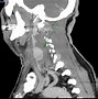 Image result for Carotid Artery Tumor