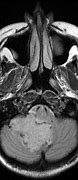 Image result for Choroid Plexus Papilloma MRI