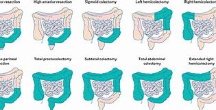 Image result for 10 Cm Tumor in Colon