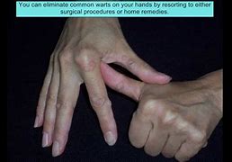Image result for Types of Warts On Arm