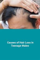 Image result for Hair Loss in Teenage Boys