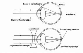 Image result for Corrective Lens for Myopia
