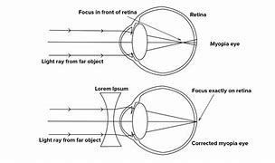 Image result for The Corrective Lens Used for Hypermetria