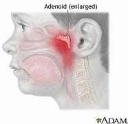 Image result for adenoidds