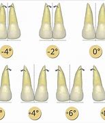 Image result for Rotated Central Incisors