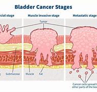 Image result for Sessile Bladder Tumor