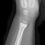 Image result for Dislocated Forearm