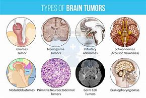 Image result for Brain Tumor Types