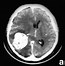 Image result for Cat Scan Benign Brain Tumor