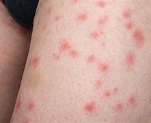 Image result for What Does Bed Bug Bites Look Like On Humans
