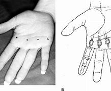Image result for Trigger Thumb Injection