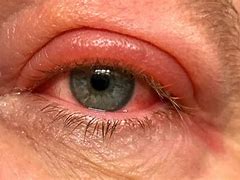 Image result for Common Eyelid Growths