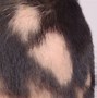 Image result for alopevia