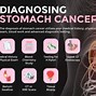 Image result for Stomach Cancer Signs