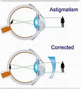 Image result for Cylindrical Lenses for Astigmatism
