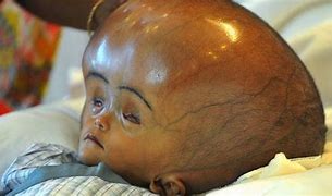 Image result for Hydrocephalus Face