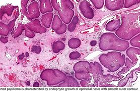 Image result for Nasal Inverted Papilloma