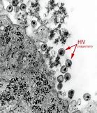 Image result for HIV Warts