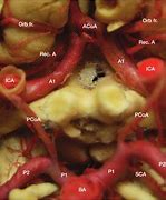 Image result for Internal Carotid Artery Pathway