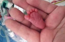 Image result for World's Smallest Baby