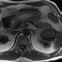 Image result for Pancreatic Cyst
