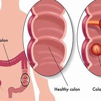 Image result for Average Size of Colon Polyps