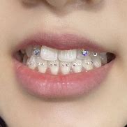 Image result for Blinged Out Teeth Gems