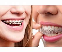 Image result for Invisible Line Braces