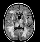 Image result for encefalomielitos