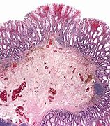 Image result for Serrated Polyp