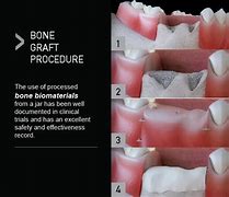 Image result for Wisdom Teeth Bone Fragments