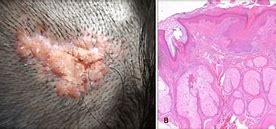Image result for Scalp Papilloma