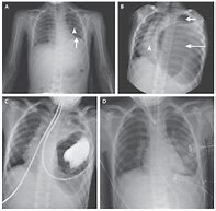 Image result for Traumatic Diaphragmatic Hernia
